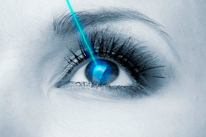 Cirugí­a refractiva láser